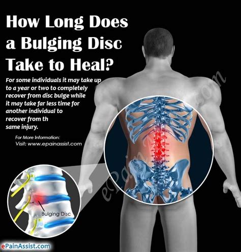 I went to a neurosurgeon who took at look was very worried at first, because i did not know how to alleviate the symptoms when they arose, or how to prevent them from arising as often. How Long Does a Bulging Disc Take to Heal?