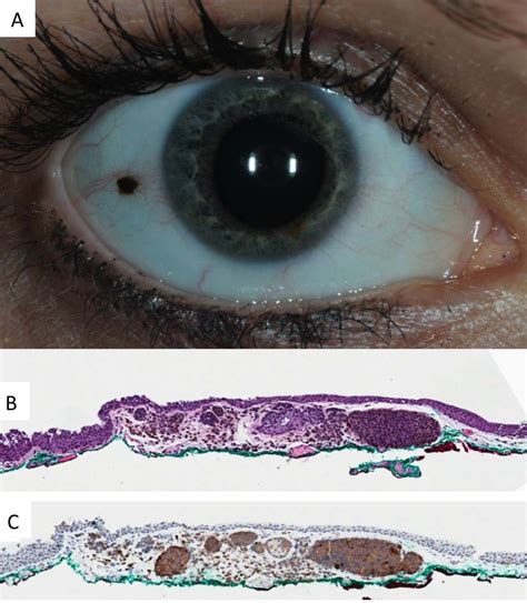 Conjunctival Nevus Occurring In Adulthood A Clinical Photo