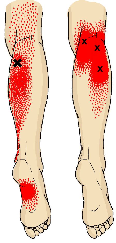 Leg Pain Leg Pain Calf