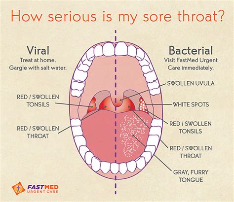 Strep Throat Sore Throat Fastmed Urgent Care