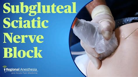 Subgluteal Sciatic Nerve Block Youtube