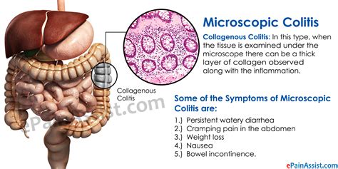 In addition, eliminating high fiber foods such as beans and nuts are also important to a lymphocytic colitis diet, as extra fiber can exacerbate your already unpleasant symptoms. Microscopic Colitis: Treatment, Diet, Symptoms, Diagnosis ...