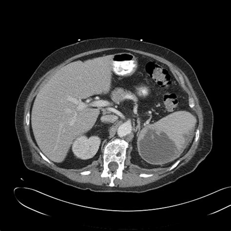 Tissue Plasminogen Activator In The Percutaneous Drainage Of Splenic