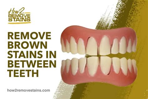 How To Remove Brown Stains In Between Teeth Detailed Answer
