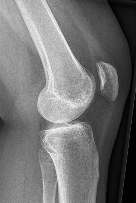 Also seen is some trochlea (groove of femur) dysplasia (abnormal shape). X-knee - Startradiology