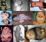 Marijuana Effects On Unborn Babies Images
