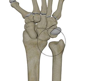 DRUJ Instability Treatment Seattle Wrist Pain Bellevue WA Wrist Dislocation Pacific Northwest