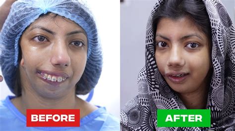 The Most Stunning Plastic Surgery Transformation Youtube