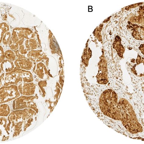 Representative Images Of P16 Immunostaining In A P16 Cytoplasmatic