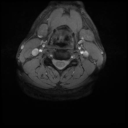 Normal Mri Cervical Spine Image Radiopaedia Org