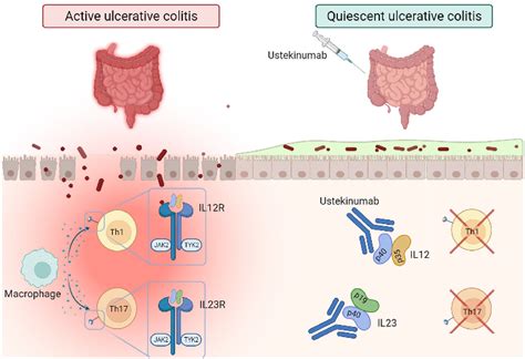 Targeting IL12 23 In Ulcerative Colitis Update On The Role Of