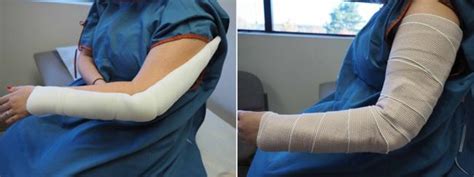Distal Humerus Fractures Of The Elbow Orthoinfo Aaos