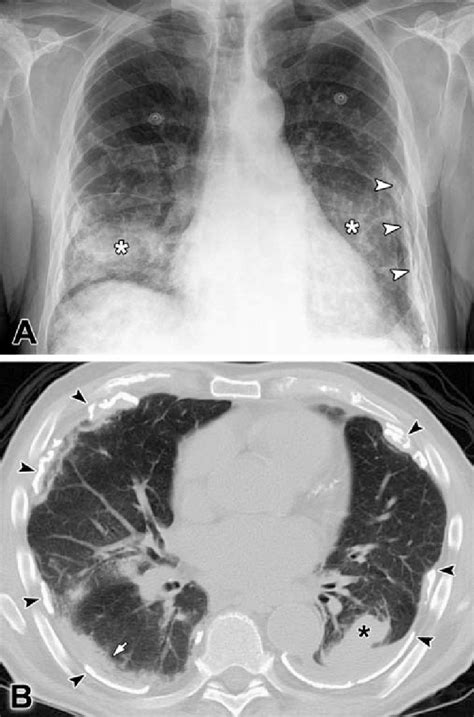 A Posterior Anterior Pa Chest Radiograph Demonstrates Extensive