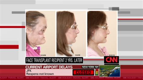 Transplant Recipient Expresses Satisfaction With Her New Face On Life