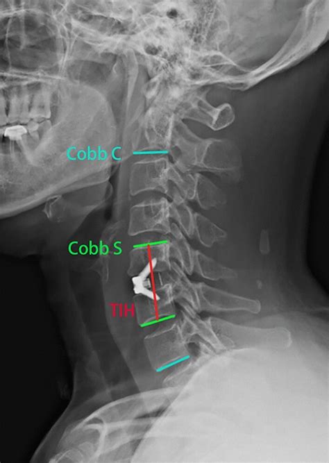Lateral X Rays Of The Cervical Vertebra Cobb C The Cobb Angle Between