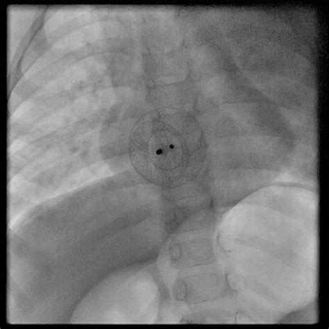 Atrial Septal Defect Device Closure Sujyotheartclinic