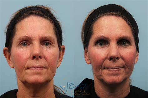 Face Lift And Neck Lift Before And After Photos Patient 201 Vancouver Bc