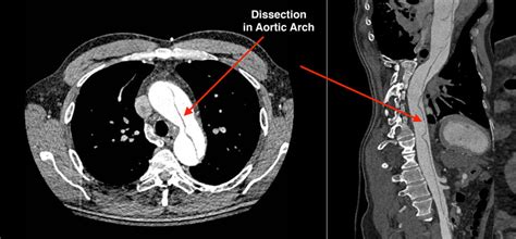 Patient S Ct Scan Showing The Aortic Dissection With