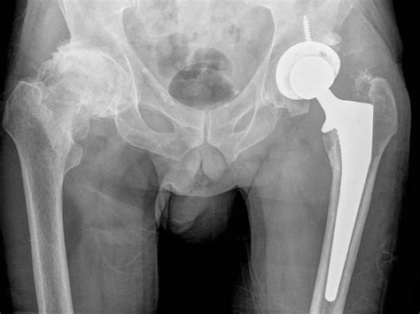 Hip Replacement Adelaide Total Hip Replacement Adelaide Dr Sunil Reddy