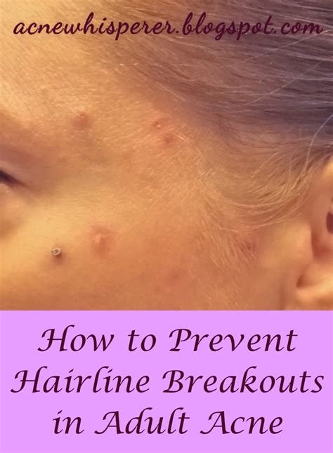 The Acne Whisperer Easy Fixes For Hairline Breakouts