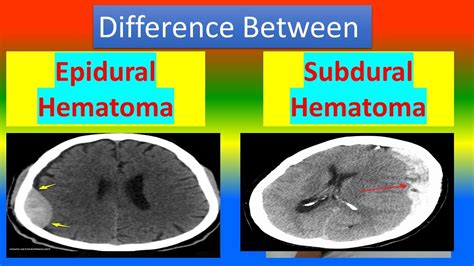Difference Between Epidural Hematoma And Subdural Hematoma Youtube
