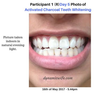 Activated Charcoal Teeth Whitening Experiment 2 Real Beforeafter Pics