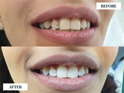 Laser Teeth Whitening To Obtain A Perfect Smile Stunning Dentistry Blog