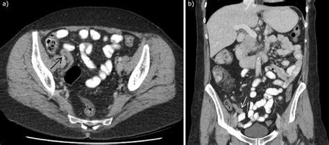 Ct Abdomen With Intravenous And Oral Contrast Demonstrating Enlarged