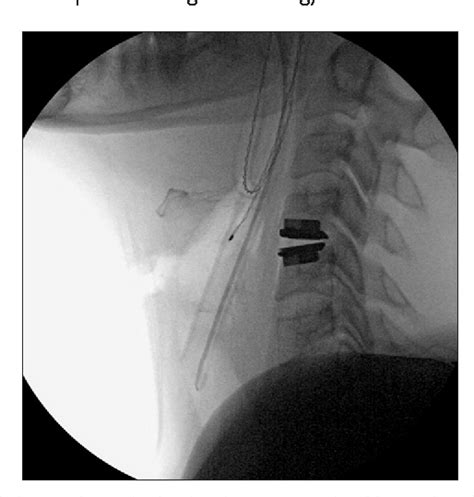 Figure 1 From Cervical Artificial Disc Extrusion After A Paragliding