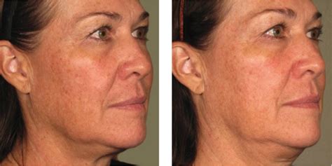 Ultherapy Nyc Non Surgical Facelift Manhattan Tribeca Medspa