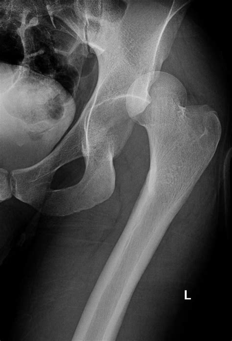 Hip Dislocation Orthopedics Medbullets Step 23