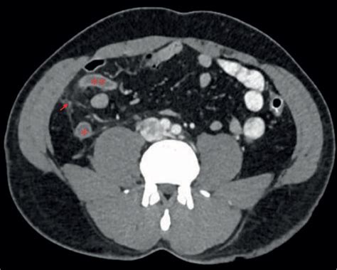 Abdomen CT Scan With IV And Oral Contrast Showing Dilated Appendicular