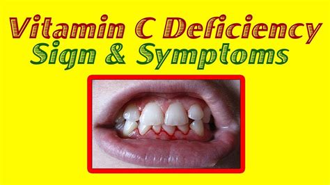 Vitamin C Top 10 Signs And Symptoms Of Vitamin C Deficiency YouTube