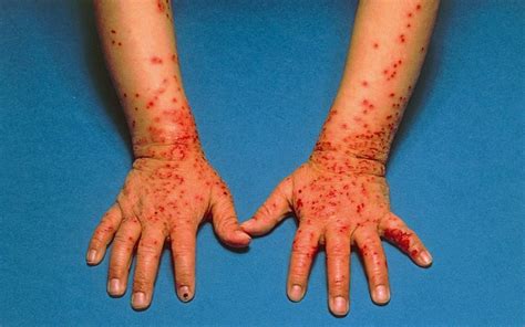 Diagnosing Blistering Skin Conditions Gponline