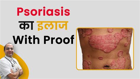 Psoriasis Treatment With Proof सोरायसिस का हुआ इलाज Psoriasis