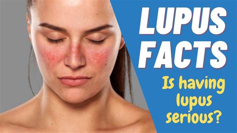 30 Facts About Lupus That You Really Should Know About Lupus Facts