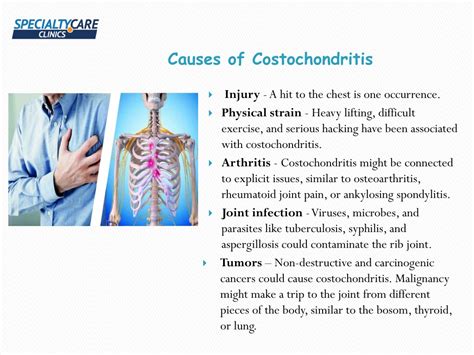 Ppt Costochondritis Powerpoint Presentation Free Download Id10830019