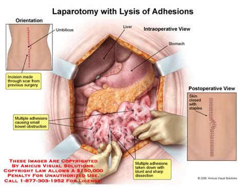 Amicus Illustration Of Amicus Surgery Laparotomy Lysis Adhesions Midline Bowel Obstruction Scar