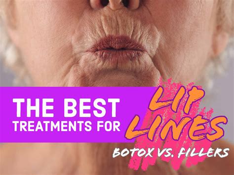 The Best Treatments For Lip Lines Botox Vs Fillers Dr Carolyn Mai
