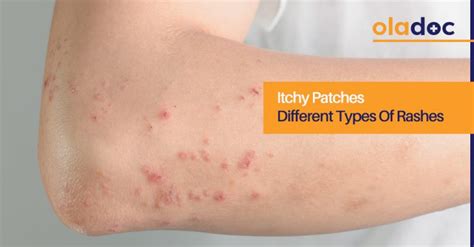 Itchy Patchesdifferent Types Of Rashes