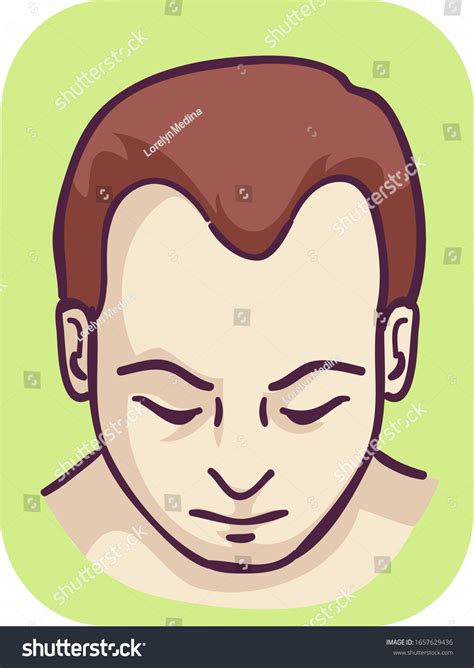 M형 대머리선 상실을 가진 남자의 사례 스톡 벡터로열티 프리 1657629436 Shutterstock
