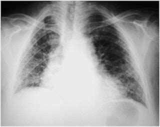 New conceptual models of pulmonary microbiology and pneumonia pathogenesis. Liga de Patologia - UFC: Pneumonias Adquiridas na Comunidade