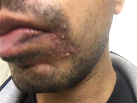 Strange Small Bumps On Chin Help Please General Acne Discussion By