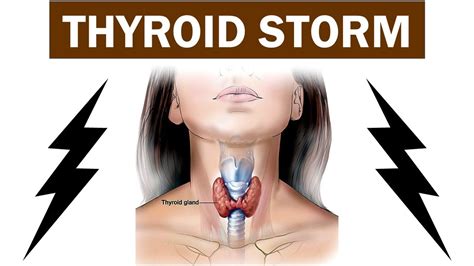 Thyroid Storm Youtube