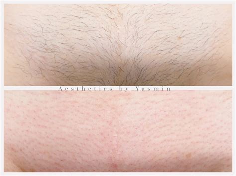 Brazilian Wax Before And After Pics