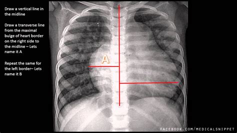 How To Measure Cardiomegaly In Cxr Youtube