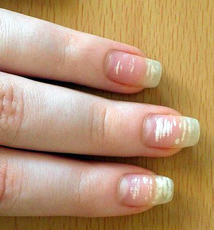 Irregular white spots on nails (called leukonychia) are usually caused by minor impact damage to the nail bed. Leukonychia - White Spots on Nail
