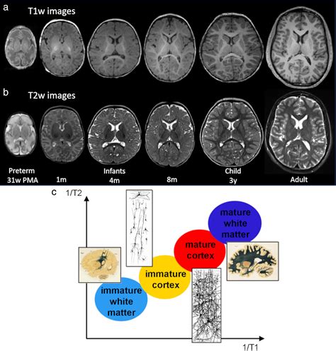 Mri Of The Neonatal Brain A Review Of Methodological Challenges And