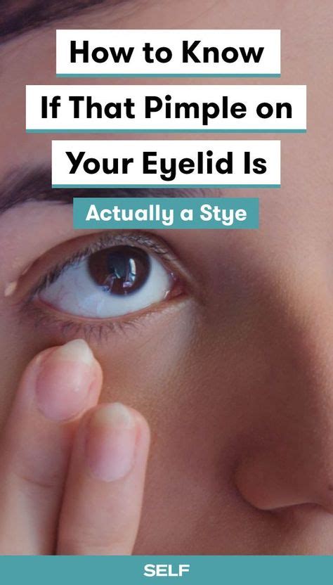 That Pimple On Your Eyelid Might Not Actually Be A Pimple Pimples