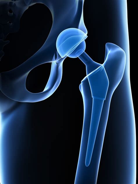 Types Of Total Hip Replacement Doctorvisit